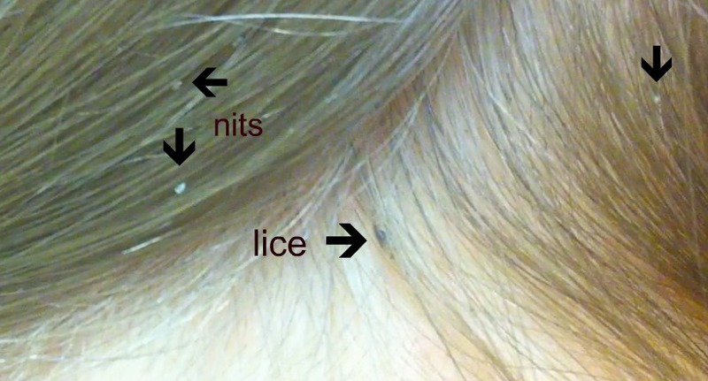 48+ Lice Eggs In Blonde Hair Background